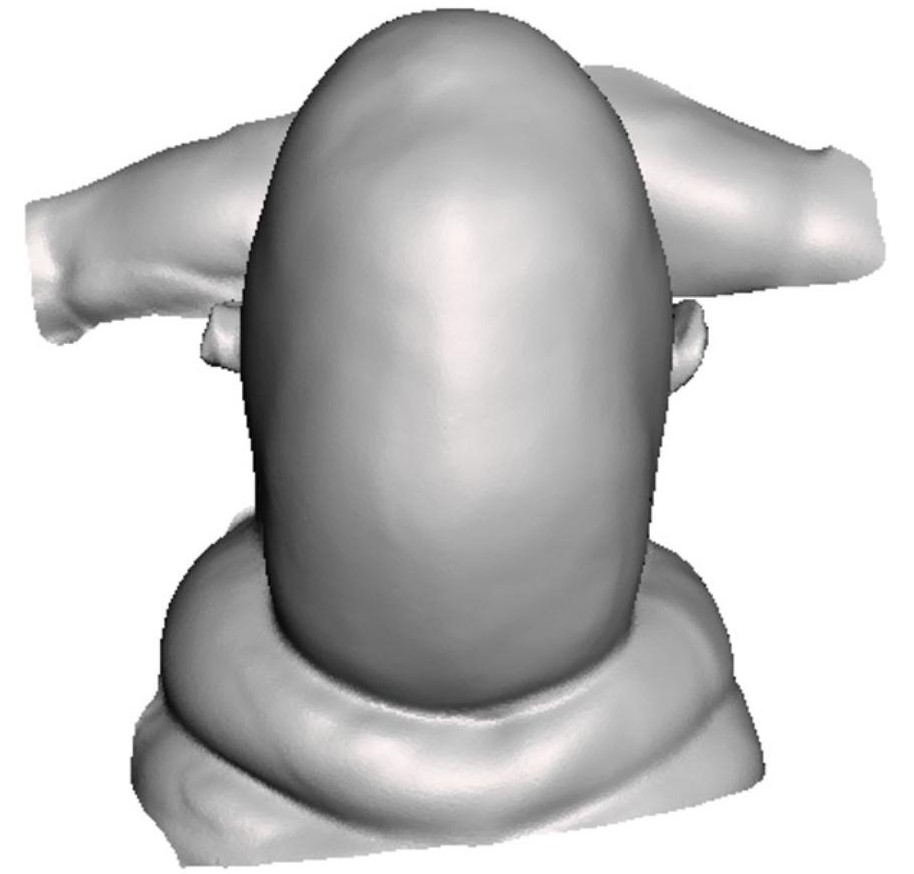 craneosinostosis